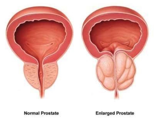 Enlarged prostate.jpg